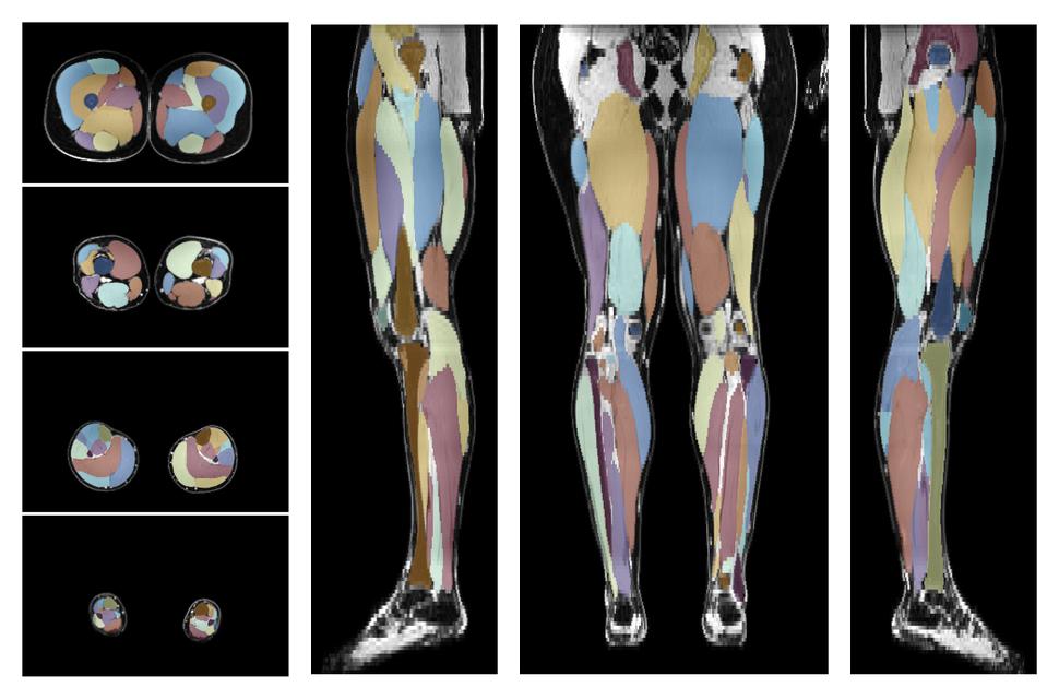 Overlay of automated muscle segmentation labels on dixon water image.